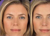 Mésothérapie du visage à l'acide hyaluronique à domicile Mésothérapie du visage sans utilisation d'acide hyaluronique