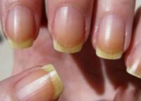 How to whiten nails at home - cosmetics and folk recipes